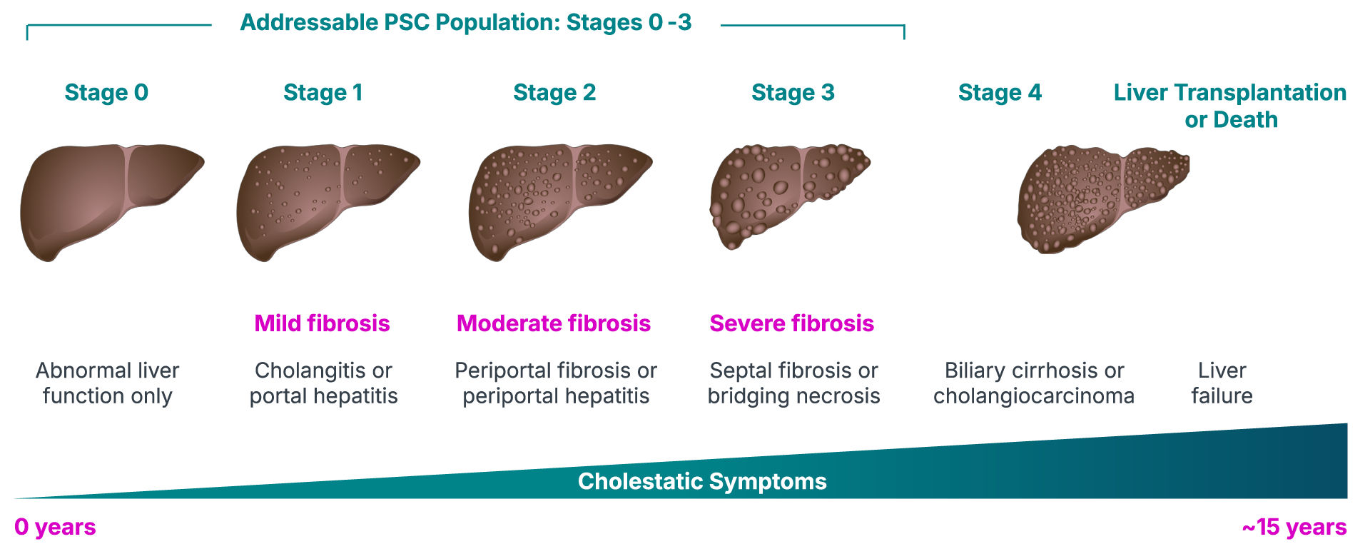 PSC Staging and Progression